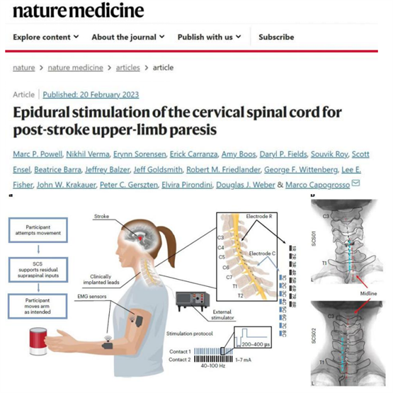 首创！重医附一院神经外科开展脊髓电刺激双电极植入治疗卒中后偏瘫