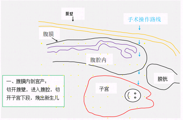 无痛生娃是真的吗？做过2000多例腹膜外剖宫产术的产科权威专家有话说！