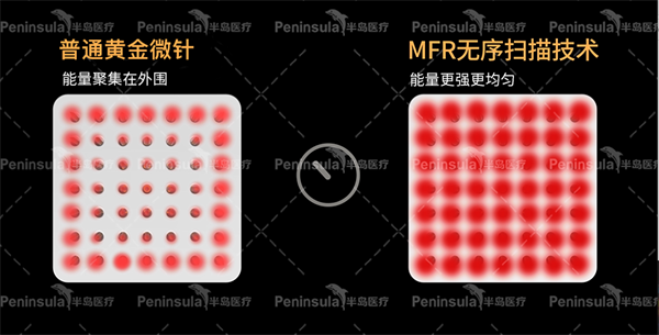 第五代半岛黄金微针颠覆式技术创新，告别疼痛，实现真皮全层精准抗衰